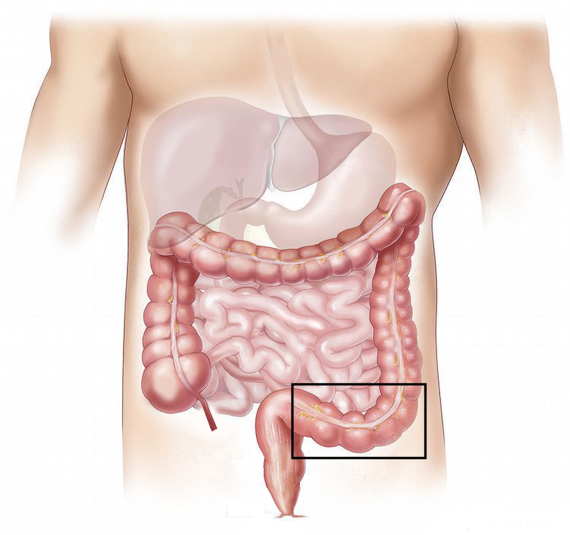 Chirurgie Colorectale Cisss De Laval