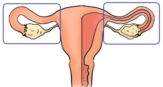 Salpingo-ovariectomie bilatérale