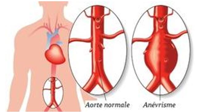 Image d'une aorte